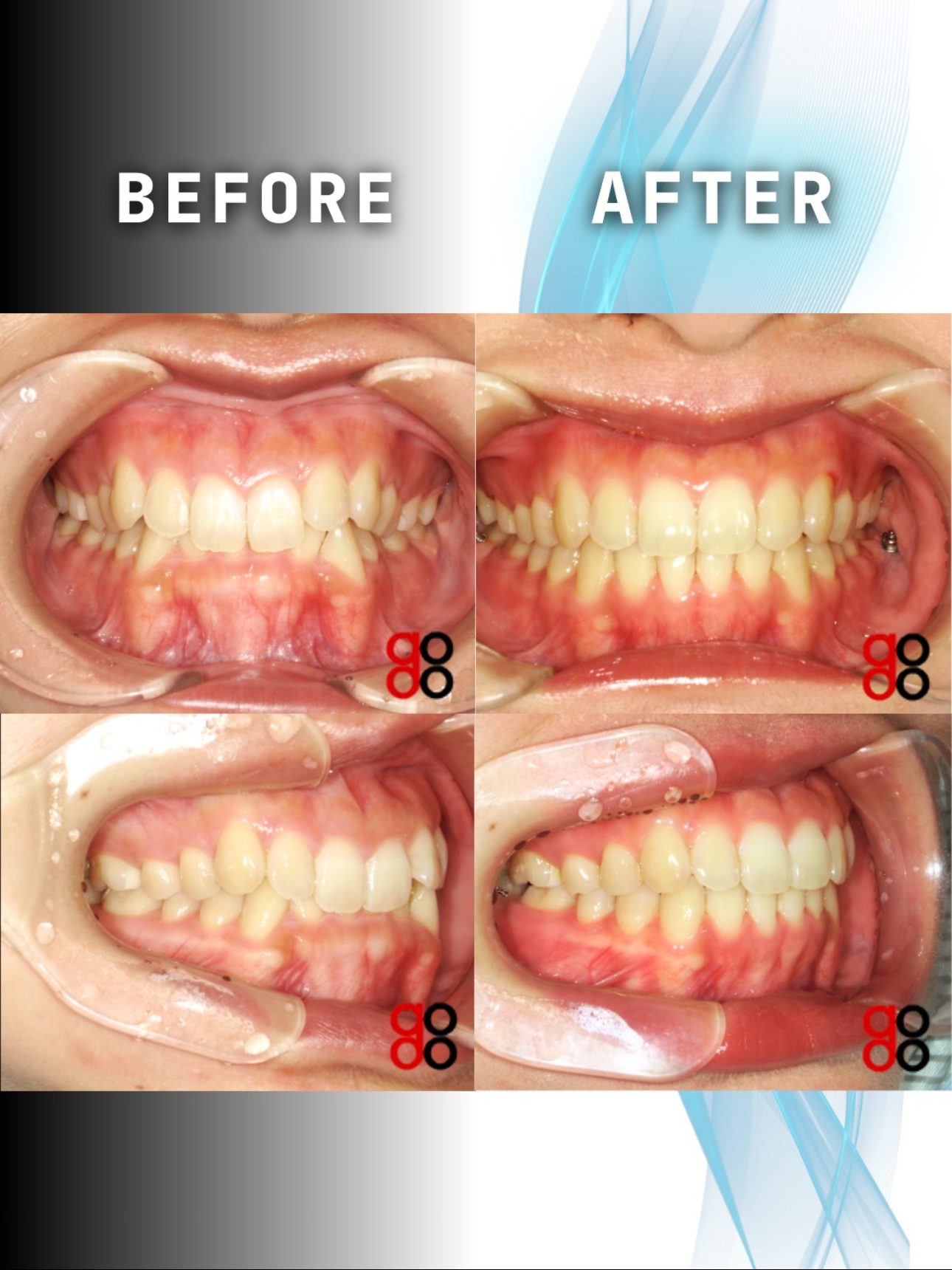 コラム-裏側矯正よりハーフリンガルの方が仕上げは難しい （理由を3つ