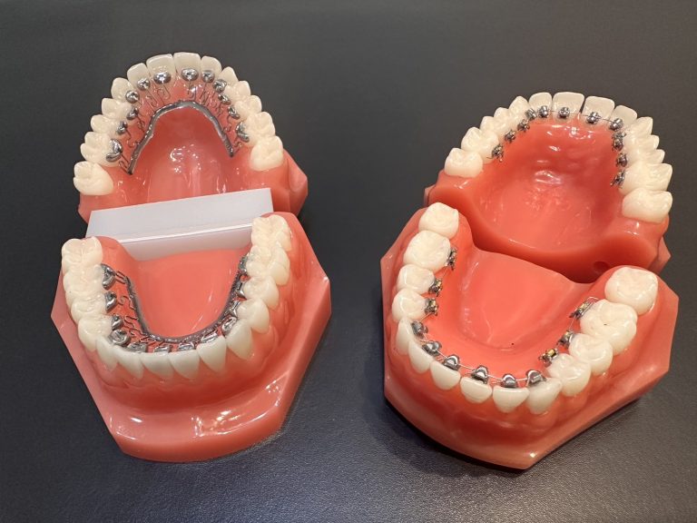 銀座矯正歯科で選択可能な裏側矯正、BravaとFLB。