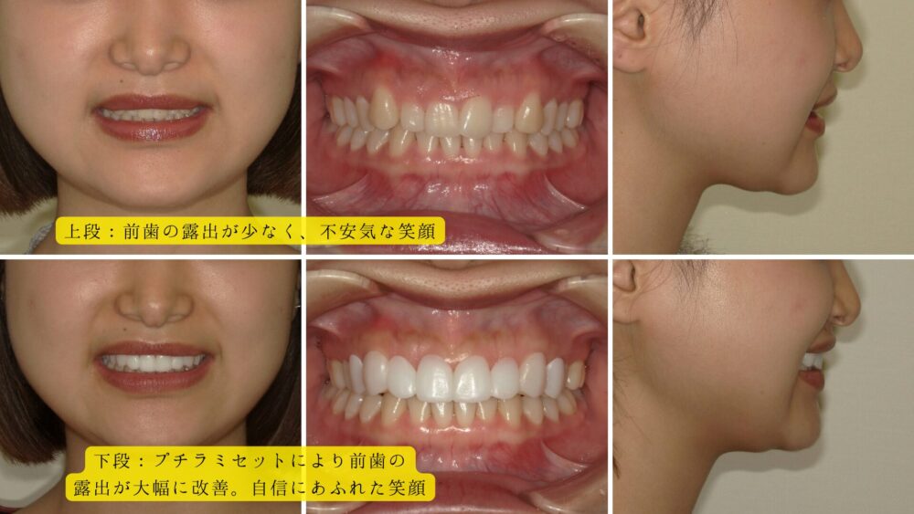 プチラミセット前後で笑顔に劇的な変化が生まれています。