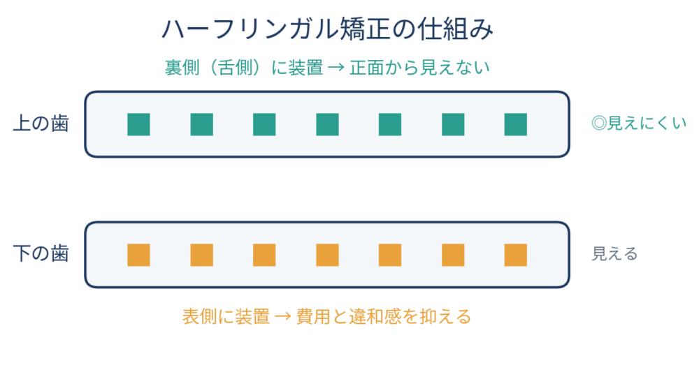 ![ハーフリンガル矯正の仕組みを示す図。上顎の歯は裏側（舌側）に装置、下顎の歯は表側に装置を配置し、正面から見ると上の装置が見えないことを表す模式図。]