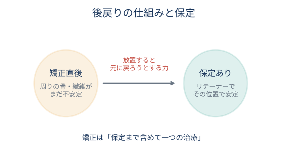 ![矯正後の後戻りの仕組みを示す模式図。動かした直後の歯の周りの骨・歯根膜・繊維がまだ安定しておらず、元の位置へ戻ろうとする力が働くことを矢印で表現。保定によりその位置で安定させる流れを併記。](【画像5-1 URL】)