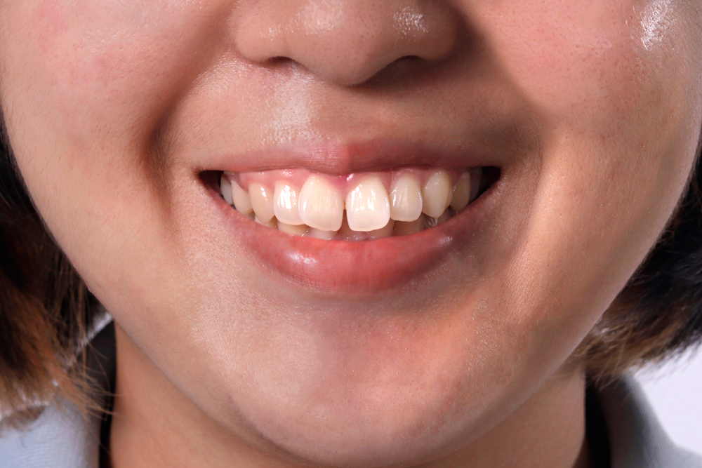 八重歯は矯正すべきか？治療するメリットや治療方法は？