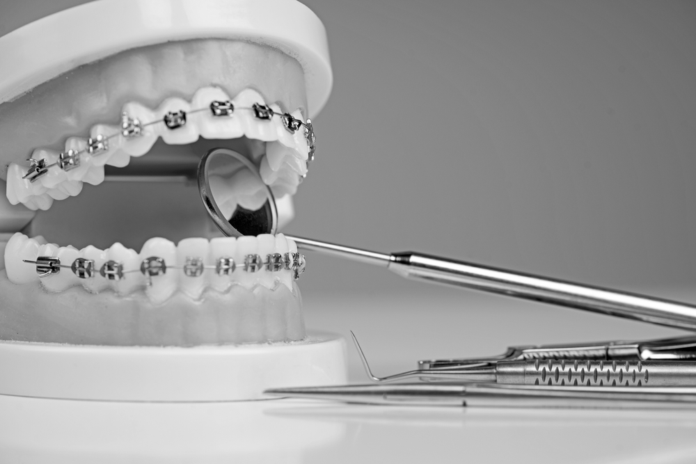 歯列矯正に用いる器具・装置の種類を紹介！それぞれのメリット・デメリットも