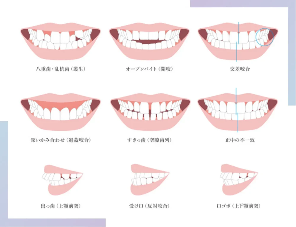歯並びの症状