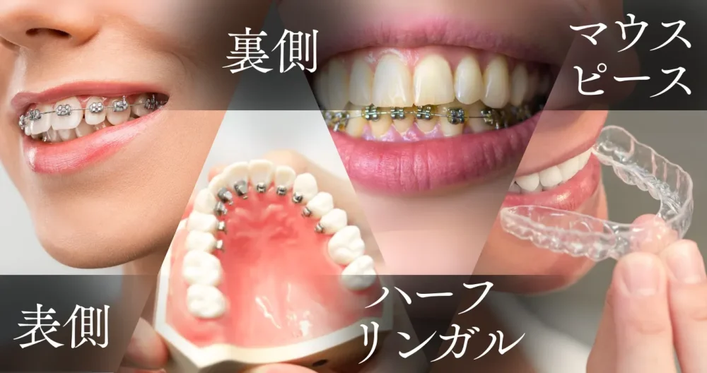矯正治療の種類